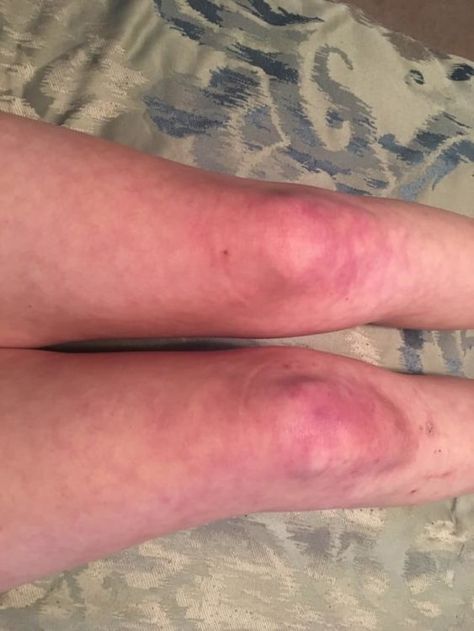 Why Do My Legs Turn Purple, Blue Fingers, Purple Veins, Rheumatic Diseases, School Core, Spots On Legs, Red Veins, Feeling Numb, Red Patch