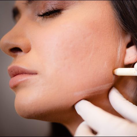 💉 Fillers - Strategic placement of dermal fillers along the jawline can give the appearance of a more angled, sculpted look. Fillers add volume which enhances the jaw structure. 🔻 Evoke - This is a nonsurgical micro-invasive treatment that uses radiofrequency to reduce fat and tighten skin, creating an often immediate effect! 🌡 Ultherapy - Ultherapy is the only FDA-cleared treatment that utilizes ultrasound technology to stimulate a face ‘lift’. 🌐 Visit drjenniferlevine.com Jaw Angle, Jawline Filler, Bridal Bootcamp, Small Business Instagram, Tighten Skin, Ideal Shape, Aesthetic Medicine, Business Instagram, Face Lift