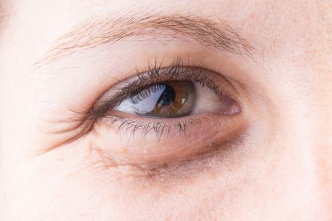 9 Causes of Dark Eye Circles - Take action to reduce dark circles under eyes with natural, noninvasive methods Osteoporosis Diet, The Ayurveda Experience, Swollen Eyes, Eyelid Lift, Dark Eye Circles, Under Eyes, Dark Circles Under Eyes, Dark Under Eye, Reduce Dark Circles