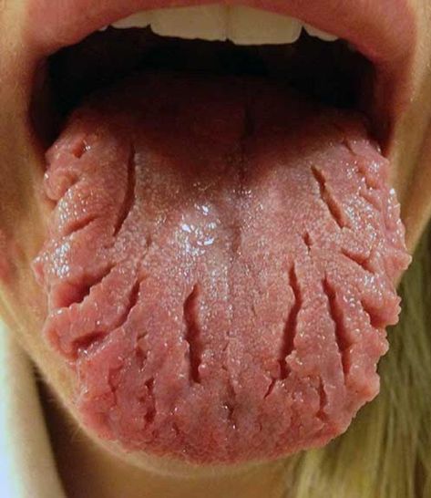 30 Pictures That Will Make You Feel Super Uncomfortable Cracked Tongue, Human Oddities, Tongue Health, Dental Assistant, Dental Hygiene, Human Condition, Oral Hygiene, Medical Conditions, Oral Care