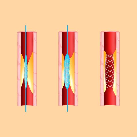 Do You Really Need a Heart Stent? Here's When You Should Say No. Heart Stent, Orthotics And Prosthetics, Parts Of The Heart, Bypass Surgery, Heart Muscle, Coronary Arteries, Diet And Exercise, It's Never Too Late, American Heart Association