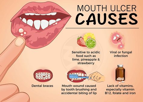 MOUTH SORES: EVERYTHING YOU NEED TO KNOW Ulcer Remedies, Ulcer Remedies Mouth, Mouth Ulcer, Foods For Healthy Skin, Dental Braces, Nail Infection, Canker Sore, Cold Symptoms, Acidic Foods