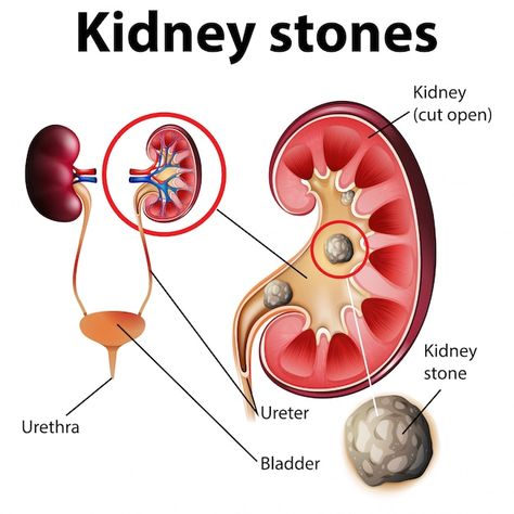 Informative Illustration, Kidney Anatomy, Renal Calculi, Human Kidney, Human Body Structure, Kidney Stone, Human Body Anatomy, Human Body Systems, Heart And Lungs