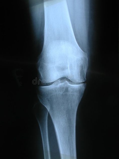 Knee. X-ray of a knee , #Sponsored, #Knee, #ray, #knee #ad X Ray, Skeleton, Disease, Bones, Character Art, Stock Images, Medical, Art