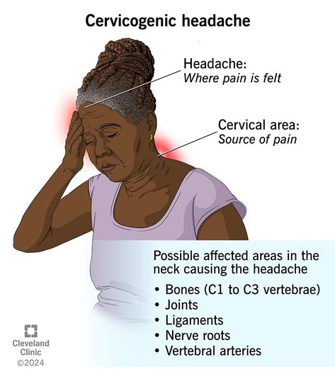 What Is a Cervicogenic Headache? Cervicogenic Headache Relief, Thunderclap Headaches, Headache Chart, Cervicogenic Headache, Vertebral Artery, Headache Causes, Referred Pain, Headache Types, Head Pain