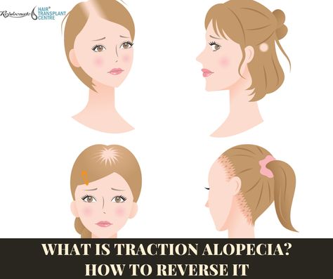 Hair Growth Tips For Alopecia, Alopecia Photography, Traction Alopecia Hairstyles, Tension Alopecia, Frontal Fibrosing Alopecia Hair Pieces, Alopecia Headwear, Scarring Alopecia, Traction Alopecia Regrowth, Alopecia Hair Growth