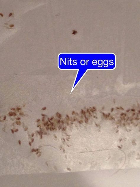 Lots of nits (eggs) Lice Eggs, Lice Removal, My Saves