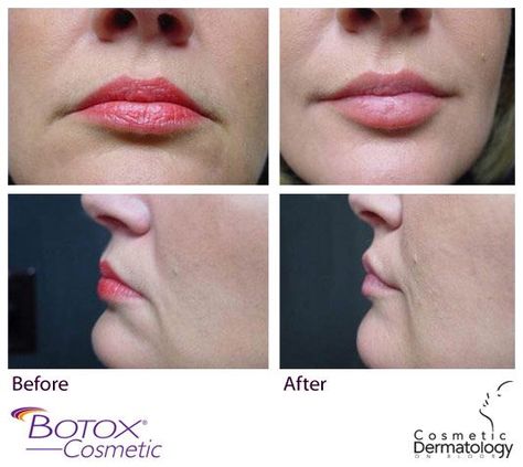 Downturned Lips, Downturned Mouth, Botox Before And After, Body Under Construction, Botox Cosmetic, Cosmetic Dermatology, Cosmetic Procedures, Lip Fillers, Young And Beautiful