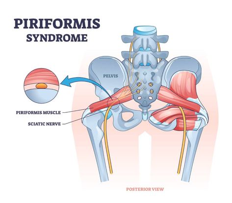 Piriformis Syndrome Piriformis Syndrome Exercises, Sciatic Nerve Pain Relief, Tension Release, Piriformis Muscle, Hip Pain Relief, Piriformis Syndrome, Health Words, Sciatica Pain Relief, Lower Back Pain Exercises