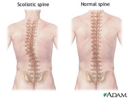 when to consider scoliosis surgery #backpain #spinalsurgery Raindrop Technique, Spinal Fusion, Spinal Surgery, Spine Health, Spine Surgery, Heart And Lungs, Neck And Back Pain, Poor Posture, Massage Techniques