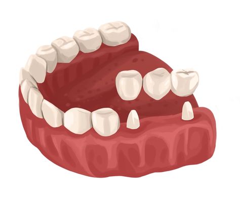 Dental Bridge Cost, Dental Wallpaper, Bridge Support, Dental Restoration, Dentist Clinic, Dental Anatomy, Dental Facts, Dental Bridge, Dental Art