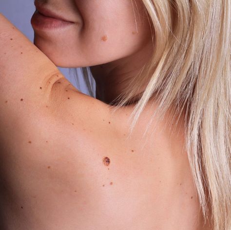 Woman with birthmarks on her back and face Cancerous Moles, Seborrheic Keratosis, Remove Skin Tags Naturally, Skin Moles, Mole Removal, Dark Underarms, Skin Issues, Flawless Skin, Dermatology