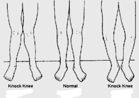 Knock Knees Test: Check yourself at home Knock Knees, Check Yourself, Medical Examination, Shoe Inserts, Medical Conditions, Growing Old, Healthcare Professionals, Knock Knock, V Shape