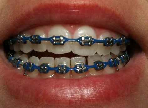 Dark Blue Braces, Power Chain Braces, Dental Braces Colors, Braces Colors Combinations, Braces Colors Ideas, Straighten Teeth, Braces Bands, Cute Braces Colors, Braces Cost