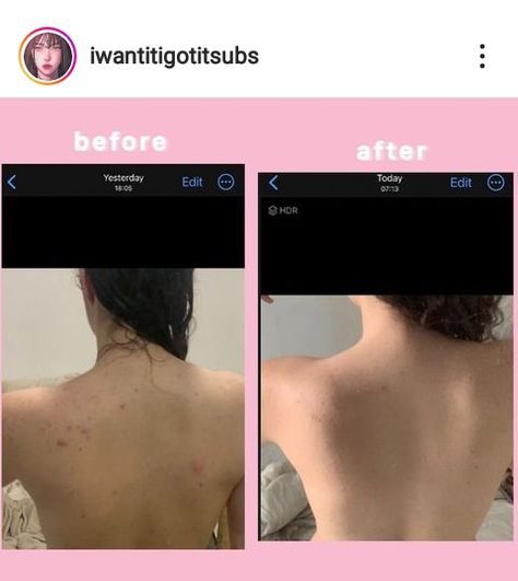 Clear Skin Subliminal Results, Subliminal Results Before And After Face, Subminal Results, Clear Back Skin, Subliminal Results Before And After, Subliminal Body Results, Subliminal Results Skin, Subliminals Results, Clear Body Skin