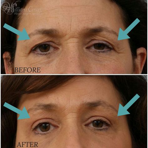 Triple Eyelid, Eyebrow Lift Surgery, Eye Lift Surgery, Forehead Lift, Eyebrow Lift, Eyelid Lift, Upper Eyelid, Botox Fillers, Brow Lift