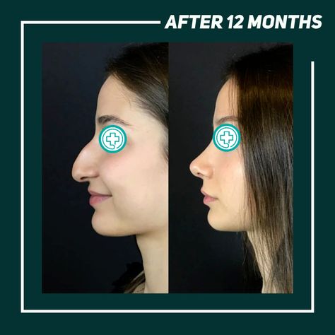 Dorsal Hump Rhinoplasty, Dorsal Hump Nose, Petite Nose, Makeup Scrapbook, Hump Nose, Visualization Board, Nose Jobs, Rhinoplasty Nose Jobs, Rhinoplasty Before And After