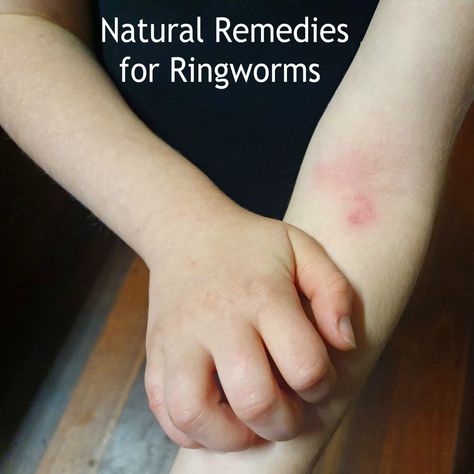 People and furbabies can be affected by ring worms. What is ringworm? Ringworm is a fungal infection of the skin. It’s not related to an actual worm, but instead gets its name from the circular rash that forms on the skin of people who’ve been infected. Ringworm is also known… Natural Ring Worm Remedies, Ring Worm Remedies, Skin Repair Cream, Fungal Infection Skin, Kids Skin Care, Essential Oil Remedy, Oil Remedies, Homemade Cleaning Solutions, Homemade Cleaning