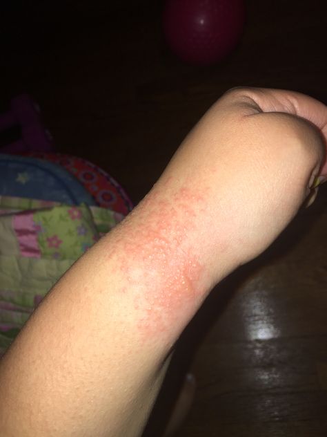 HEAT RASH, or “PRICKLY HEAT” is a condition that is caused when clothing/our skin is restricting sweat from being released from the pores of our skin. It is usually during very hot climates. This is my case of heat rash, and I got it from wearing a wrist band at Warped Tour and it was HOT AS HELL 🔥 it itches bad and bumps have formed. It is so annoying and embarrassing. I’ve tried taking a Benadryl capsule and using Benadryl itch gel, and Gold Bond cream, too! Idk what to use, next! Rash On Hands, Prickly Heat, Heat Rash, Food Captions, Dry Skin Care, Tatuaje A Color, Natural Health Remedies, Hot Yoga, Dermatology