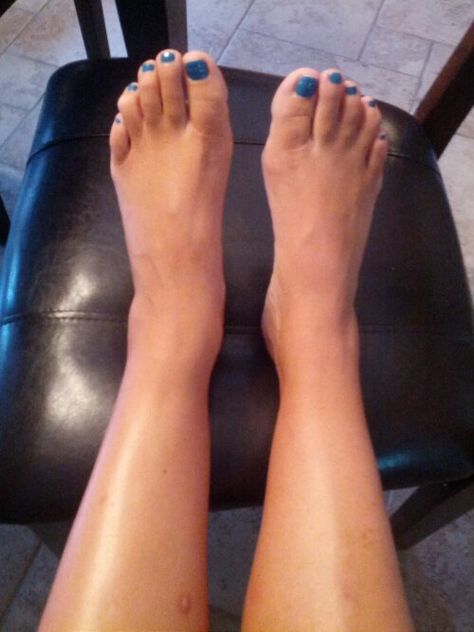 A Year Since ORIF Ankle / Leg Surgery Update – Teaching Heart Blog Post Ankle Surgery Recovery, Trimalleolar Fracture Recovery, Ankle Surgery Recovery Tips, Tibial Plateau Fracture Recovery, Ankle Fracture Recovery, Scar Tissue Massage, Trimalleolar Fracture, Ankle Surgery Recovery, Brostrom Ankle Surgery