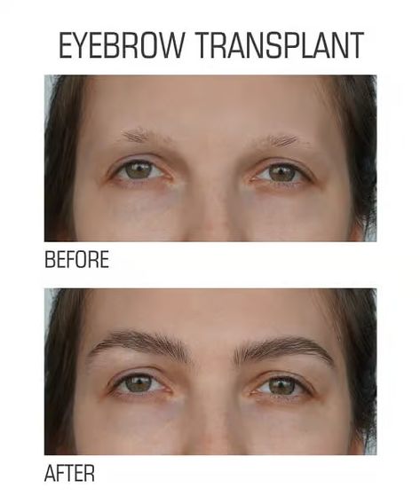 Eyebrow Transplant Surgery Eyebrow Loss, Eyebrow Hair Transplant, Eyebrow Transplant, Beard Transplant, Facial Scars, Skin And Hair Clinic, Full Eyebrows, Fue Hair Transplant, Facial Plastic Surgery