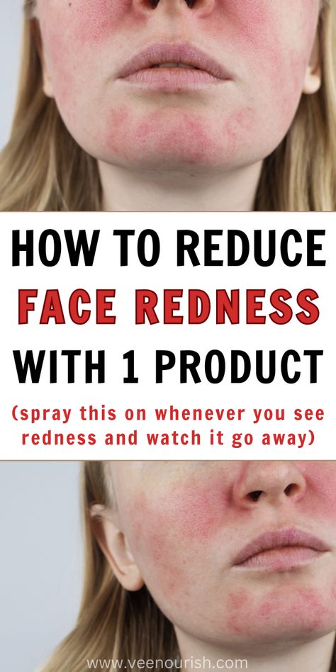 How To Get Rid Of Redness On Face With 1 Product | Skin Care Tips Face Rash Remedies How To Get Rid, How To Remove Redness From Face, How To Fix Redness On Face, How To Get Rid Of Red Spots On Face, How To Make Your Face Less Red, Get Rid Of Redness On Face, Rough Skin On Face, How To Reduce Redness On Face, Reduce Redness In Face