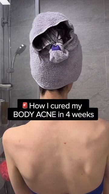 How To Get Rid Of Body Acne Fast, How To Treat Body Acne, Products For Back Acne, How To Clear Chest Acne, Backne Remedies Products, Backne Skin Care, How To Treat Back Acne, Backne Remedies Fast, How To Clear Back Acne