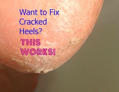 Callous Remover Diy, Dry Skin On Feet Removal Diy, Listerine Foot Soak Recipe, Cracked Heels Diy, Cracked Heel Remedies, Heal Cracked Heels, Feet Remedies, Listerine Foot Soak, Callous Remover