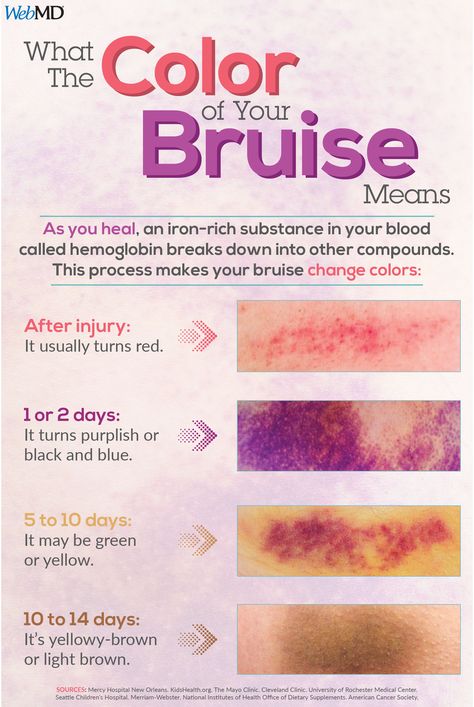 As a bruise heals, hemoglobin breaks down into other compounds. This process is what makes your bruise change colors. Materi Bahasa Jepang, Medical Student Study, Nursing School Survival, Nursing School Studying, Nursing School Tips, Medical School Studying, Nursing School Notes, Medical School Essentials, Medical Anatomy