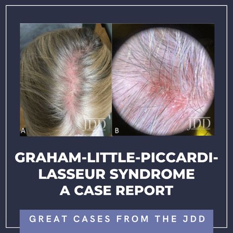 INTRODUCTION Graham-Little-Piccardi-Lasseur Syndrome (GLPLS) is a rare clinical subtype of lichen planopilaris (LPP) that manifests as a triad of scarring alopecia of the scalp, nonscarring alopecia of the axillary and the pubic skin, and widespread lichenoid follicular papules.1 GLPLS more commonly affects women (male-to-female ratio â‰ƒ 1:4), with the classic patient being a middle-aged Caucasian woman.2 While … Continue reading "Graham-Little-Piccardi-Lasseur Syndrome: A Case Report" Th Lichen Planopilaris, Scarring Alopecia, Lichen Planus, Basement Membrane, Scarring, Hair Density, The Journal, Hair Follicle, Dermatology