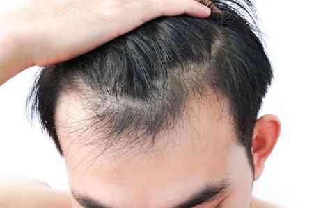 Hair loss is the primary concern of today’s era. Whether it is a male or female, everyone is affected by the hair loss issue. It involves the self-esteem and self-confidence of a person. Androgenic Alopecia, Prp Hair, Fue Hair Transplant, Hair Transplant Surgery, Best Hair Transplant, Hair Issues, Hair Specialist, Lost Hair, Skin Clinic