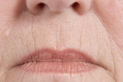 Home Remedies to Plump the Wrinkles on the Face Upper Lip Wrinkles, Botox Forehead, Chapped Lips Remedy, Lines Around Mouth, Face Masks Products, Wrinkles Around Mouth, Face Care Acne, Smokers Lines, Salt Face Scrub