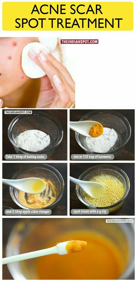 Baking Soda For Acne, Acne Scar Diy, Diy Acne, Natural Acne, Acne Scar, Dark Spots On Skin, Acne Scar Removal, Hormonal Acne, Acne Spots