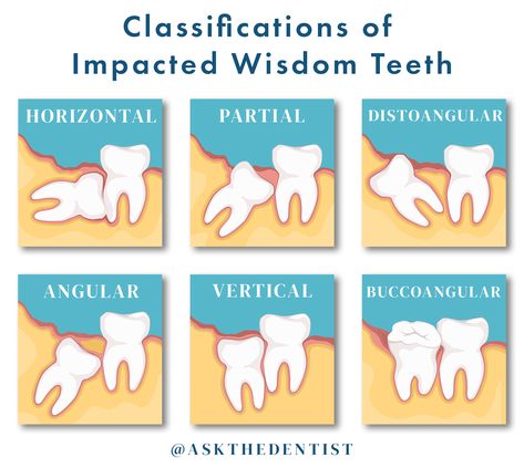 Impacted Wisdom Teeth, Wisdom Teeth Pain, Tooth Pain Relief, Teeth Surgery, Impacted Tooth, 2022 Goals, Dental Posters, Wisdom Tooth Extraction, Teeth Pictures