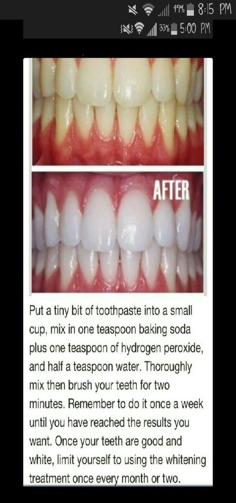 Diy Teeth, Teeth Whitening Remedies, Teeth Whitening Diy, Diy Teething, Oral Care Routine, Natural Teeth Whitening, Natural Teeth, Oral Health Care, Tooth Decay