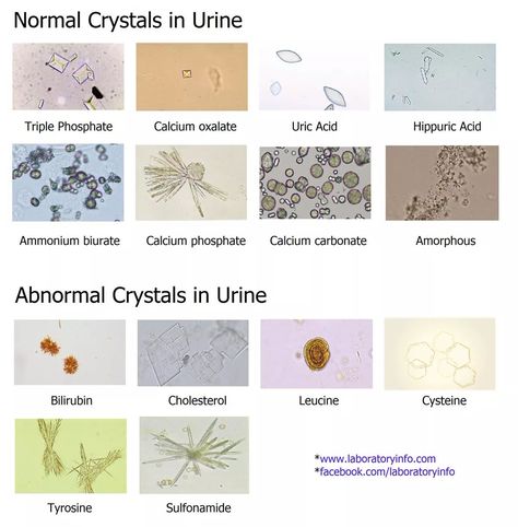 Urine Sediment Atlas, Urine Microscopic Examination, Urine Crystals, Medical Laboratory Science Student, Kidney Function Test, Nursing Labs, Medical Lab Technician, Uric Acid Crystals, Microbiology Lab