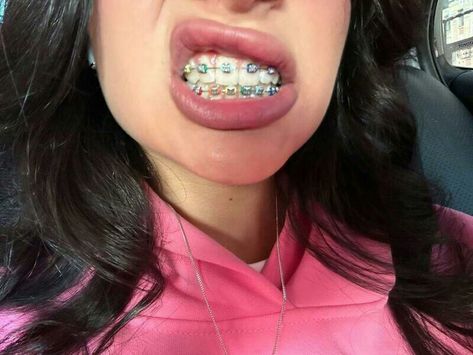 Braces Bands, Pretty Teeth, Getting Braces, Cute Braces, Beautiful Teeth, Braces Colors, Dental Braces, Perfect Teeth, Pretty Pregnant