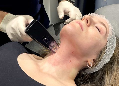 I Tried Morpheus8—and It Didn’t Hurt at All. Here’s Why. Tummy Tucks Recovery, Morpheus 8, Saggy Neck, Tech Neck, Burnt Hair, Facial Plastic, Tummy Tucks, Anti Aging Treatments, I Wish I Knew