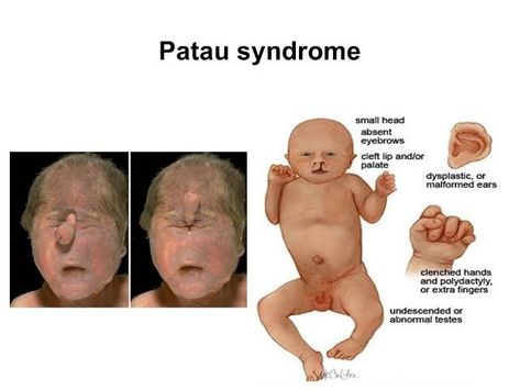 Patau Syndrome, Cleft Lip, Nurse Love, Eyebrows