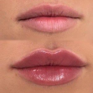 Lip Fillers Juvederm, Lip Permanent Makeup, Lips Inspiration, Permanente Make-up, Face Fillers, Botox Lips, Facial Fillers, Lip Augmentation, Facial Aesthetics