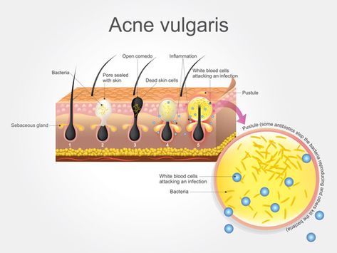 Sebum Buildup: 3 Causes & 2 Steps To Get Rid Of It - Hairguard Anatomy Body Parts, Back Acne Remedies, Greasy Skin, Acne Vulgaris, Natural Acne Remedies, Types Of Acne, Acne Causes, White Blood Cells, Face Acne