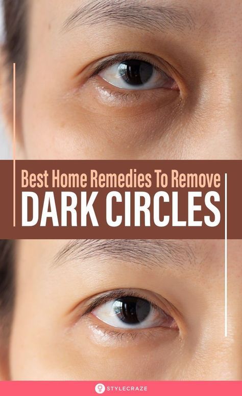 27 Best Home Remedies To Remove Dark Circles Under Eyes Permanently: If you too are one of the many individuals tormented by dark circles, worry not, there are several home remedies for dark circles. These simple and easy-to-do solutions will not only lighten your dark circles but also nourish and hydrate the skin under and around your eyes. #Beauty #BeautyTips #Remedies Remedies For Dark Circles, Dark Circle Remedies, Dark Circles Around Eyes, Dark Eye Circles, Remove Dark Circles, Under Eyes, Dark Circles Under Eyes, Dark Circle, Beauty Remedies