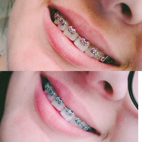 Braces colors (1-2 months) Oikawa Kinnie, Braces Journey, Braces Ideas, Orthodontic Appliances, Heart Diet, Cute Braces, Brace Face, Braces Colors, 2 Months