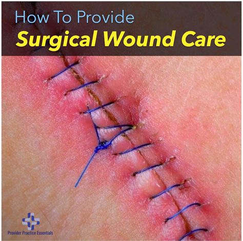 Providing Surgical Wound Care And Understanding the types of healing Open Wound Care, Wound Care Nurse, Wound Care Nursing, Pressure Ulcer, Wound Care, Scar Tissue, Wound Healing, Home Health Care, Blood Vessels