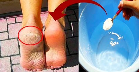 How To Get Rid Of Cracked Heels How To Soften Feet Heels, Dry Feet How To Get Rid Of, How To Get Rid Of Crusty Heels, How To Heal Cracked Feet Fast, Home Pedicure Soak Dry Heels, Healing Cracked Heels, How To Soften Feet At Home, Cracked Heel Remedy, Cracked Heels Diy