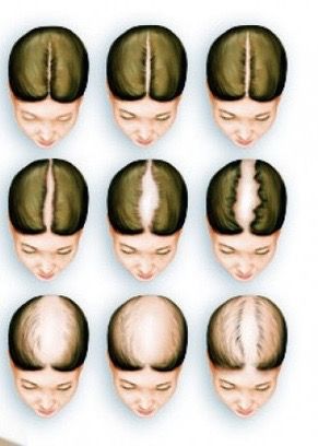 Abnormal Hair Loss Causes and Solutions  | CurlyNikki | Natural Hair Care Curly Nikki, Regrow Hair Naturally, Natural Hair Growth Remedies, Thick Hair Remedies, Female Pattern Baldness, Male Pattern Baldness, Hair Remedies For Growth, Regrow Hair, Thicker Hair