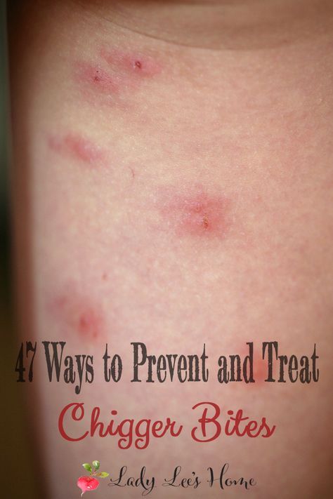 Are you covered in chigger bites and about to lose you mind? Here are 47 things you can do to treat and prevent chigger bites! Chigger Bite Remedy, Red Bugs, Bug Bites Remedies, Bite Relief, Bug Bites, Homemade Remedies, Diy Natural Products, Natural Medicine, Pest Control