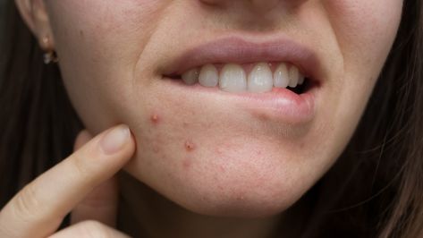 Acne can form virtually anywhere on the body, but lip acne is some of the worst. Here's how to handle it. Lip Acne Remedies, Lip Acne, Lip Pimple, Drawing Lips, Face Mapping Acne, Face Mapping, Homemade Facials, Acne Causes, Mild Cleanser