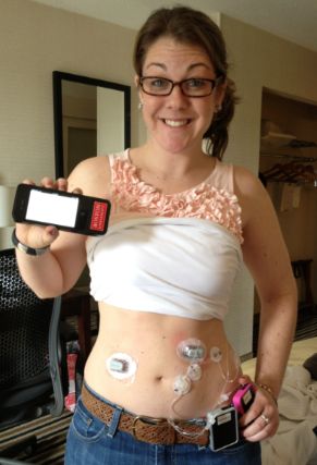 Bionic pancreas Insulin Pump, Boston University, Chronic Illness, Type 1, Disease, Turning, Boston, University, Thing 1