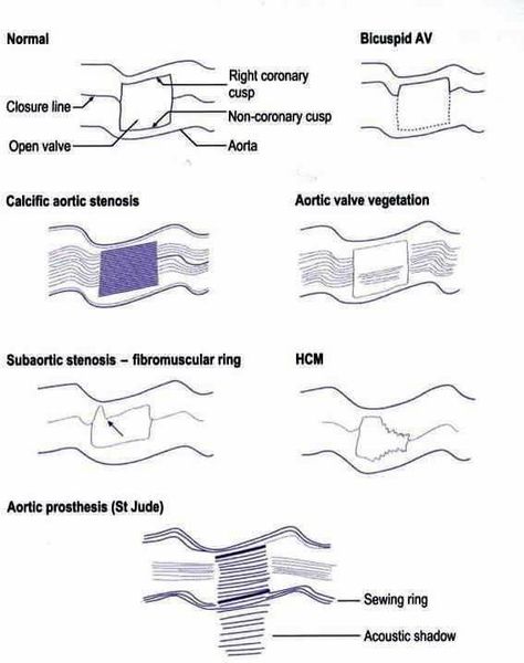 Echo Cardiography, Cardiac Ultrasound, Diagnostic Medical Sonography Student, Ultrasound School, Cardiac Anatomy, Cardiac Sonography, Aortic Valve Replacement, Sonography Student, Ultrasound Sonography